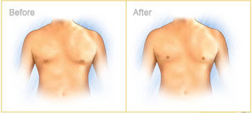 male breast reduction abroad results